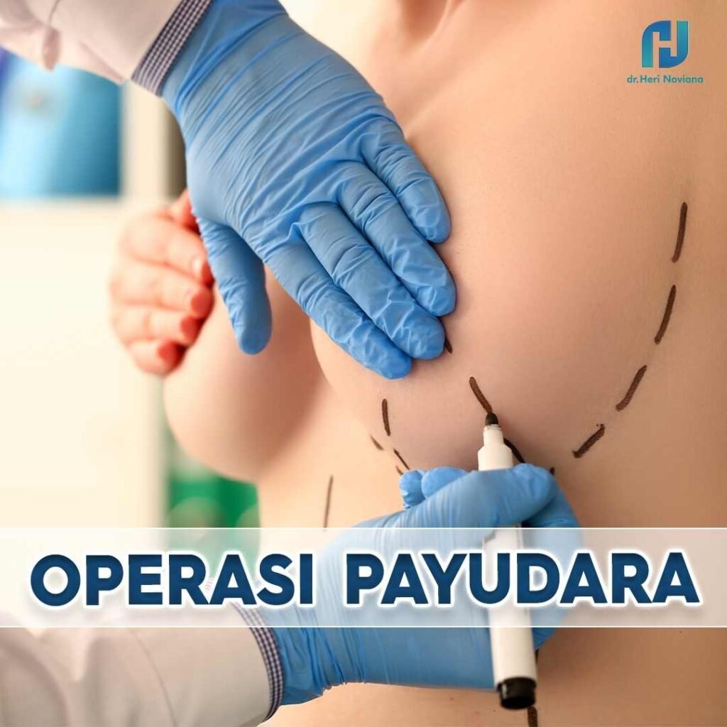 IMPLAN PAYUDARA JAKARTA